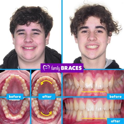 The Braces Process: Before and After Transformation Journey.